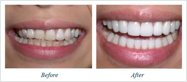 Before and after image of a patient - Veneers and Crowns in Nashville