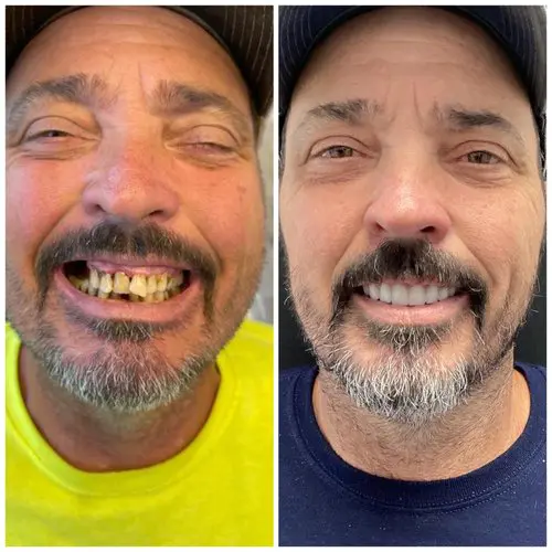 Before and After implants. Upper and lower snap in implant denture. Nashville Dentures and Implants.