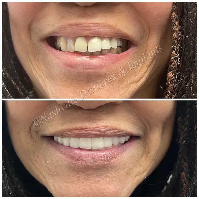 Before and After image of a patient with One day All on 4 teeth - All on 4 teeth in a day Nashville.
