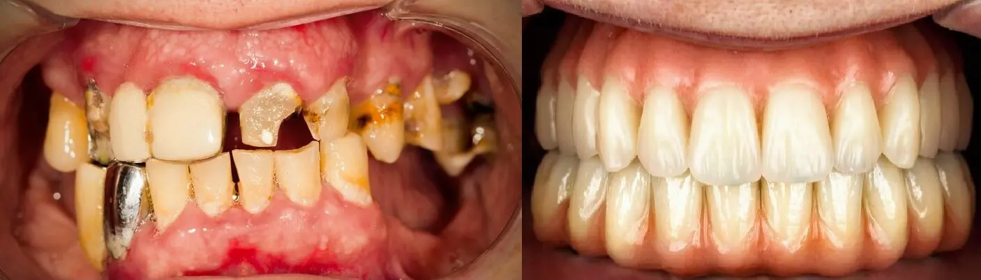 Before and after all on 4 teeth in a day. Nashville dentures and implants.