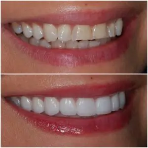 Before and after - Veneers and Crowns in Nashville.
