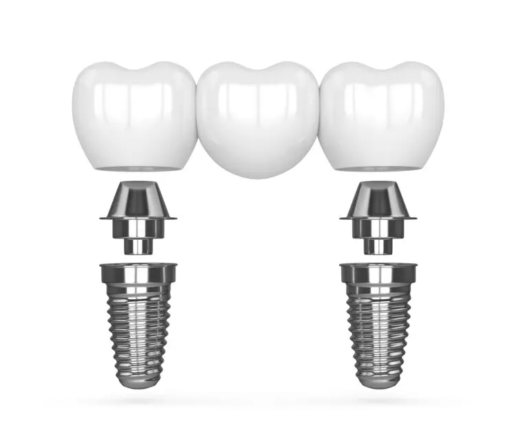a dental implants with bridge