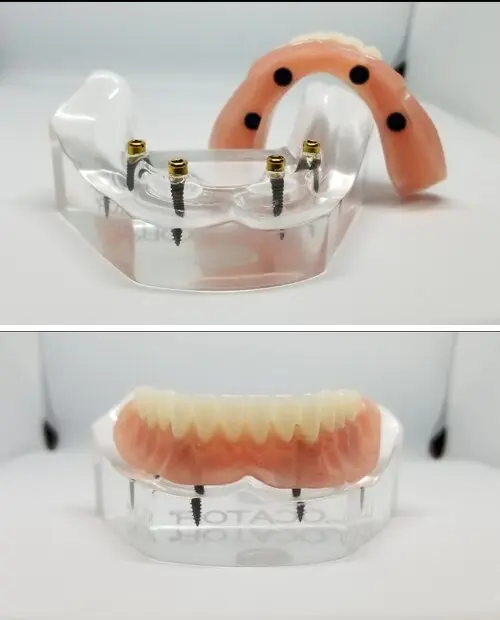 Image of a removed implant denture. Nashville dentures and implants.