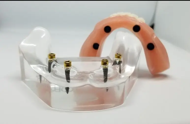 a plastic model of a human jaw and dental implants.