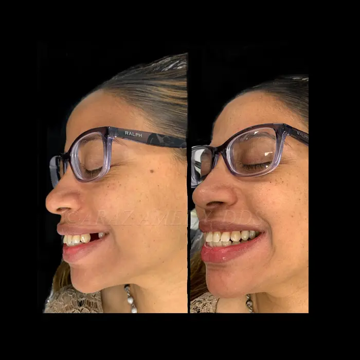 Before and after single tooth implant. Image 3