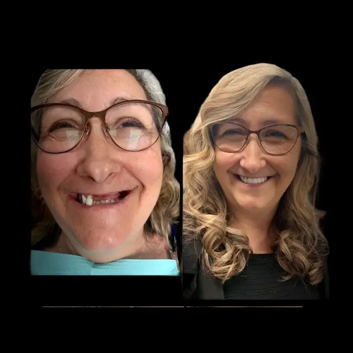 Before and after single tooth implant. Image 1