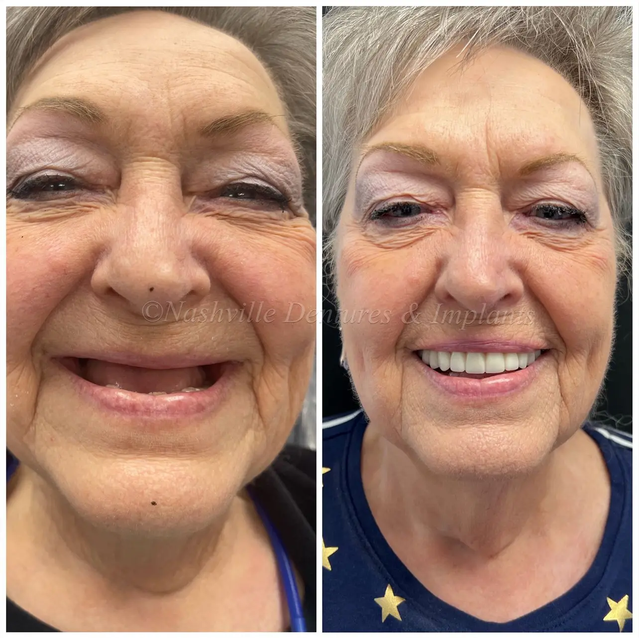 Before and after Dental Implants image10. Nashville Dentures and Implants.