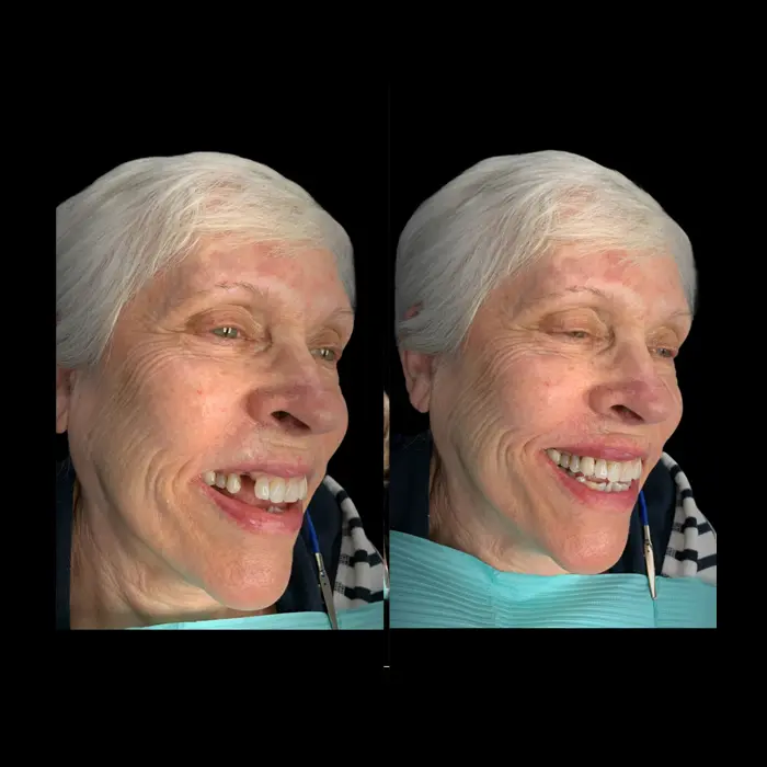 Before and after single tooth implant. Image 2. Nashville Dentures and Implants.