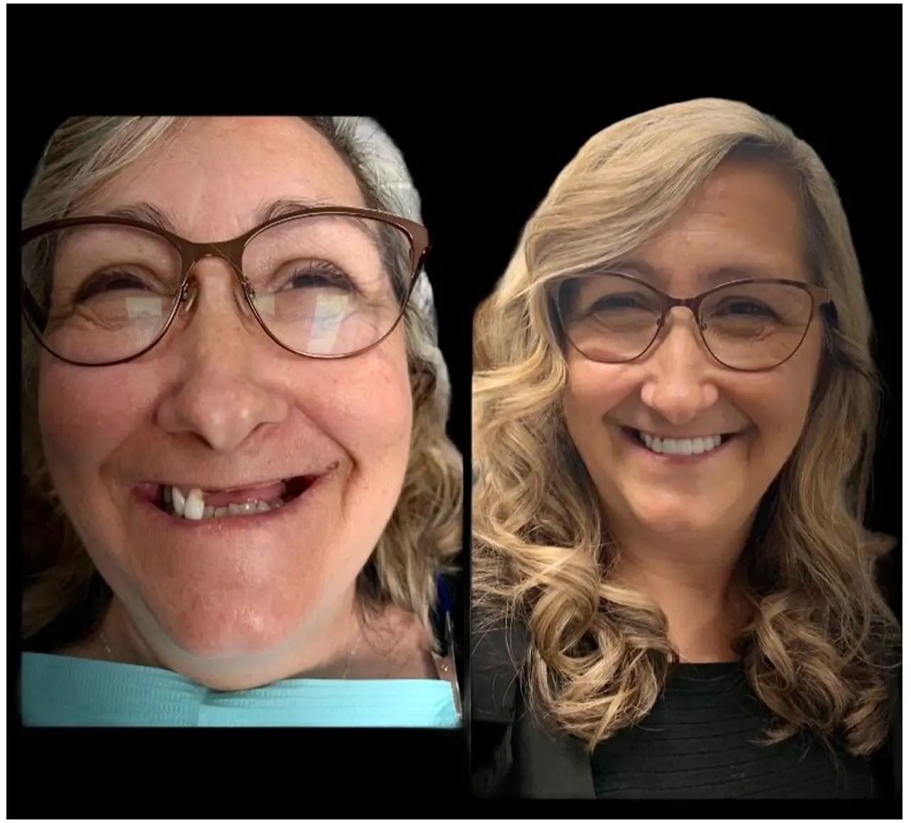 Before and after Dental Implants image 3. Nashville Dentures and Implants.