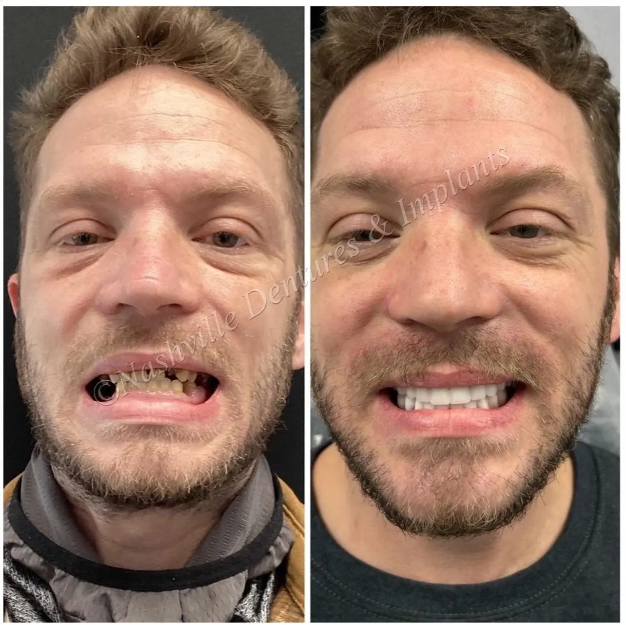 Before and after Dental Implants image 4. Nashville Dentures and Implants.