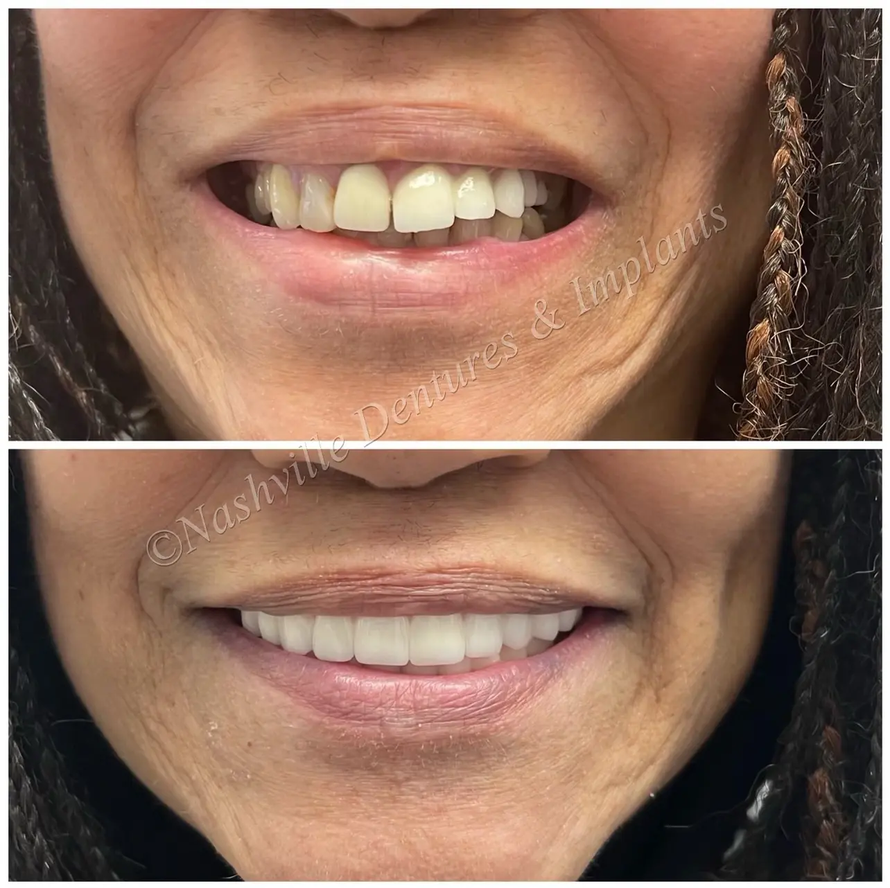 Before and after Dental Implants image 5. Nashville Dentures and Implants.