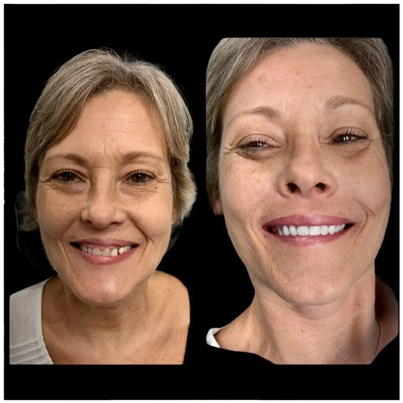 Before and after Dental Implants image 6. Nashville Dentures and Implants.