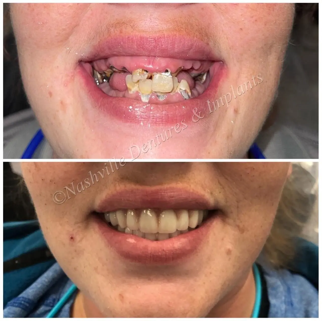 Before and after Dental Implants image 7. Nashville Dentures and Implants.