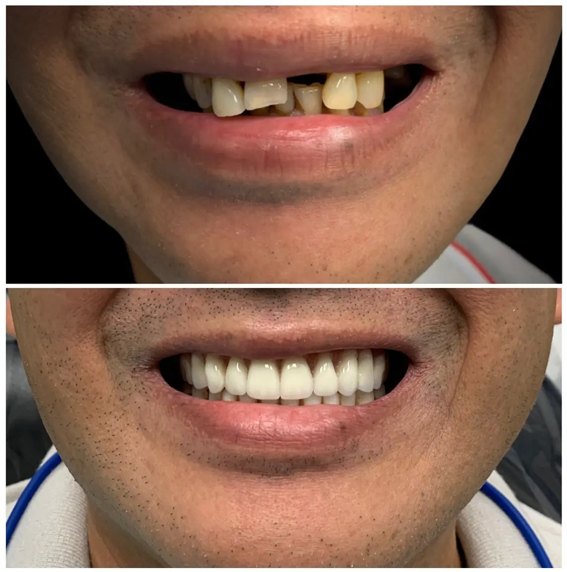 Before and after Dental Implants image 8. Nashville Dentures and Implants.