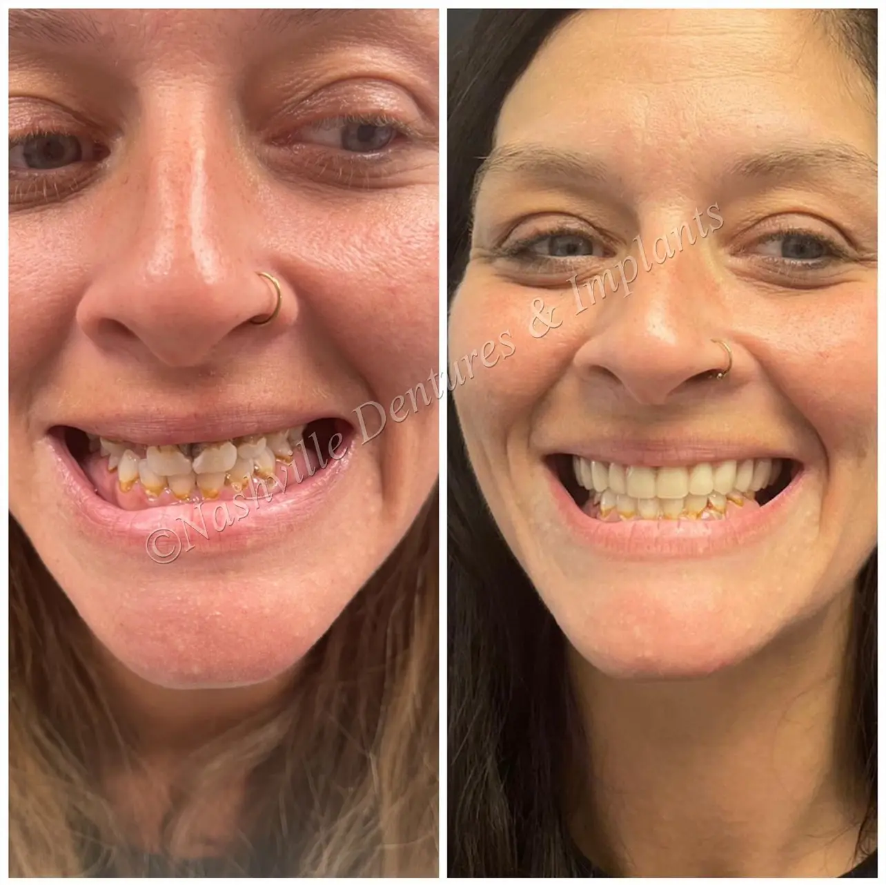 Before and after Dental Implants image 9. Nashville Dentures and Implants.