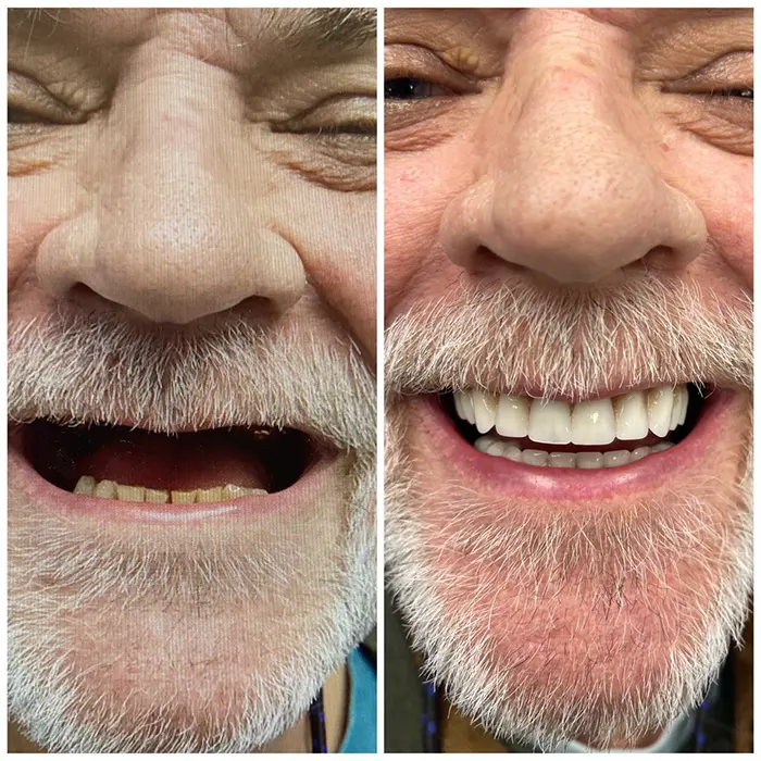 Before and After image of patient with one day all on 4 dental implants. All on 4 dental implants in Nashville