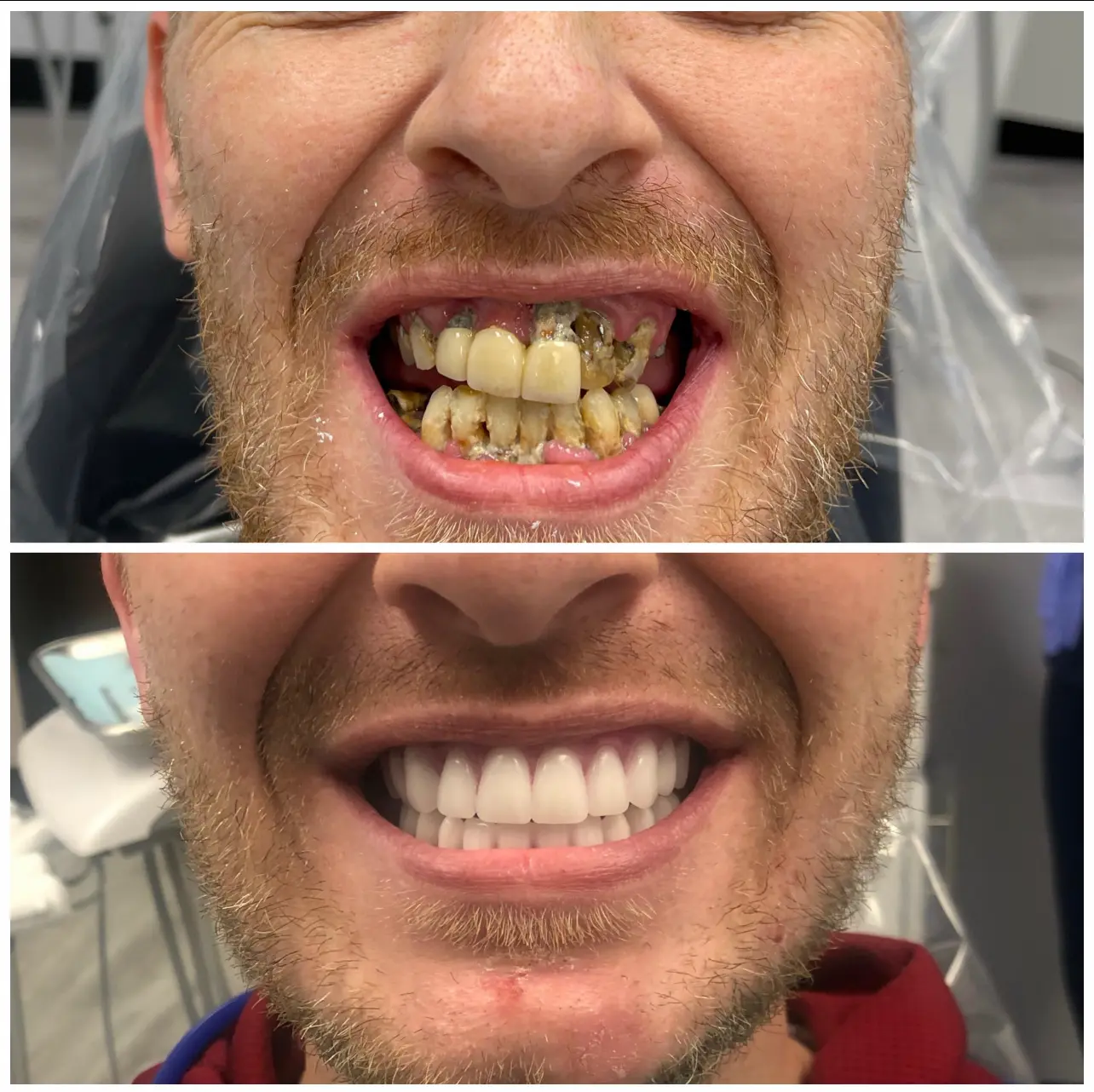 Before and after Dental Implants image 1. Nashville Dentures and Implants.