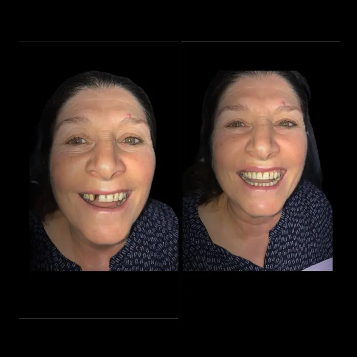 Before and after single tooth implant. Image 3