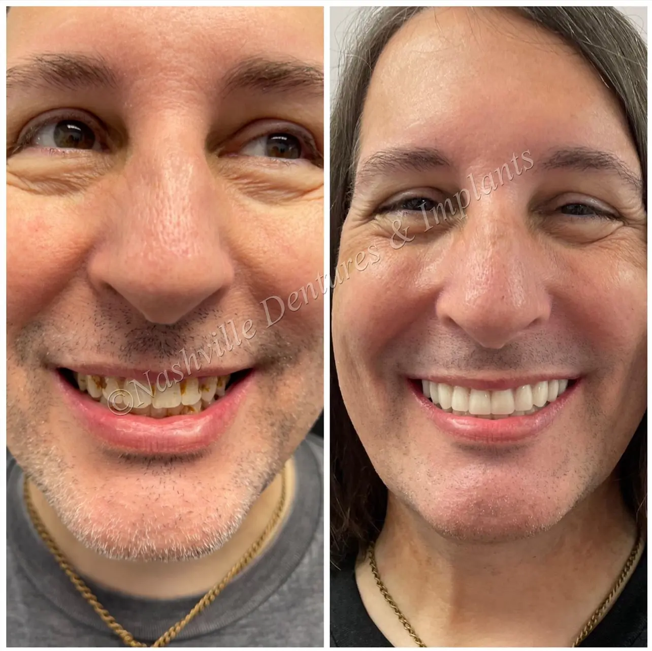 Before and after Dental Implants image 2. Nashville Dentures and Implants.