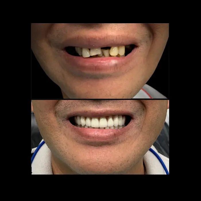 Before and after all on 4 teeth in a day. Image 2. Nashville dentures and implants.
