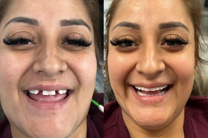 Before and after single tooth implant. Image 2