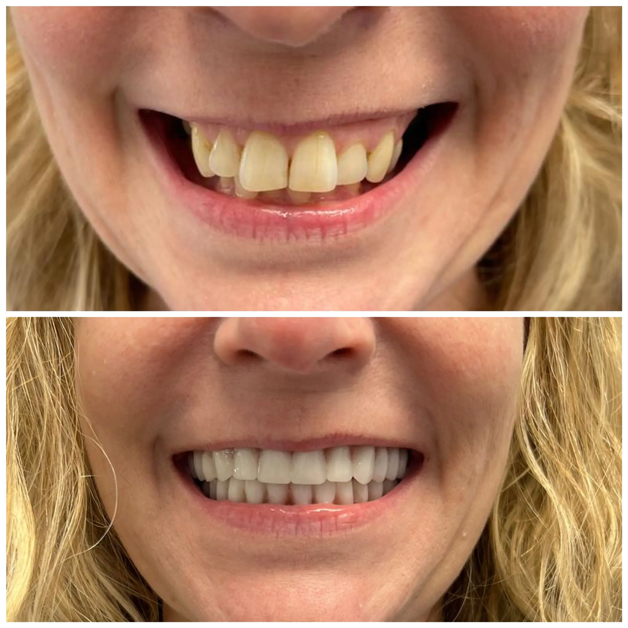 Patient image before and after - Snap in Implant Dentures Nashville