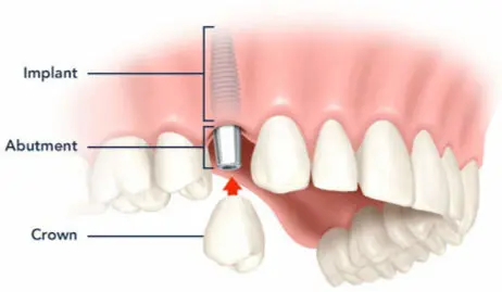 a close-up of a model of teeth