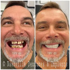 Before and after implants with Zirconia bridge. Patient image. Nashville Dentures and Implants.